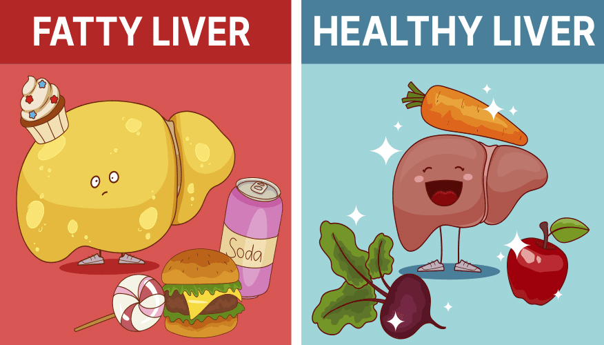 Diet impact on liver: fatty liver from junk food vs healthy liver with fruits and vegetables 