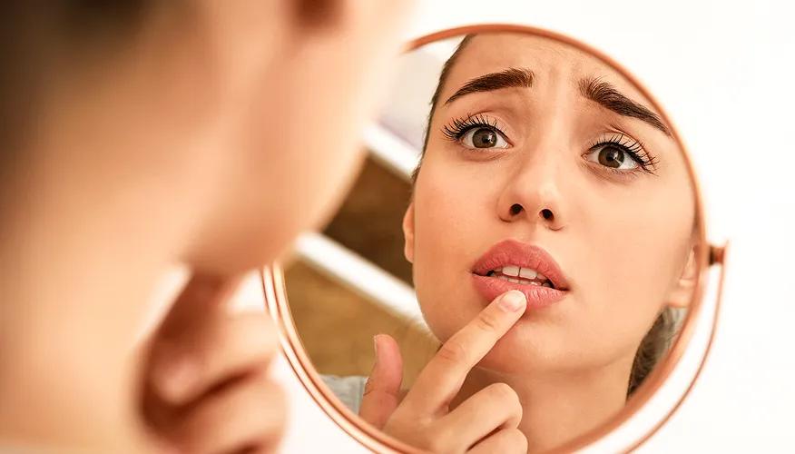 Lip dryness or chapping