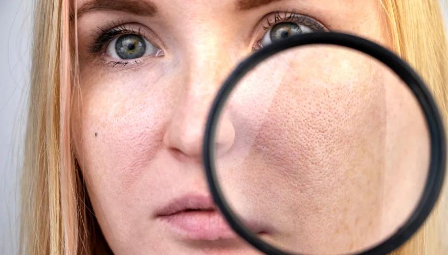 Clogged pores 