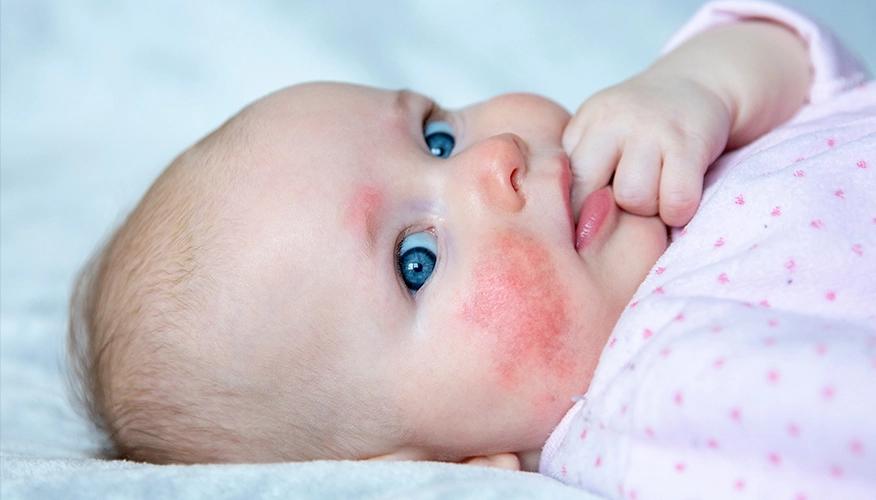 Neonatal skin diseases