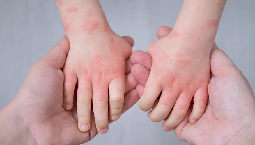 Signs Of Allergies In Newborns And Their Management