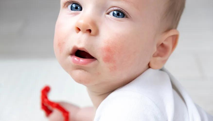 Baby Acne – What It’s All About
