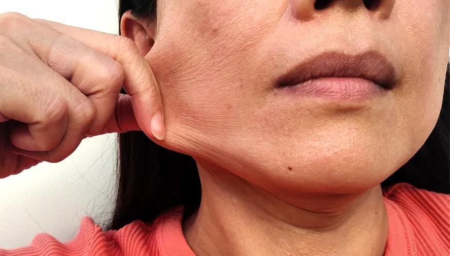 Sagging skin and jowls