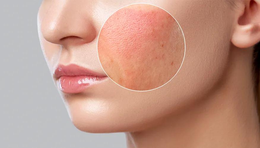  Skin irritation and allergies