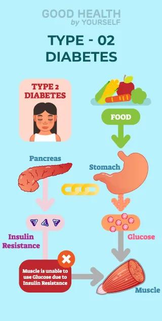 Type 2 diabetes