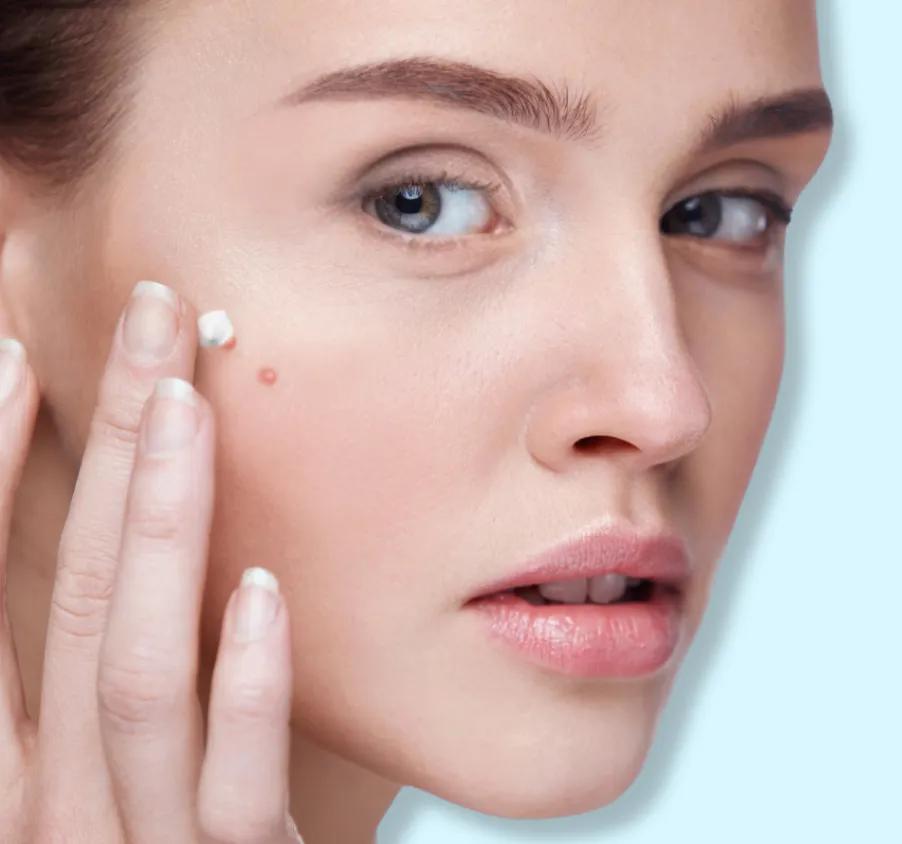 ACNACARE GEL 5