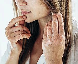 stress related eczema on hands symptoms