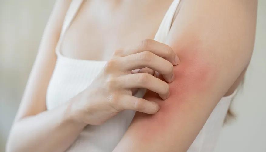 What Types Of Skin Rashes Are Common After Exercise?