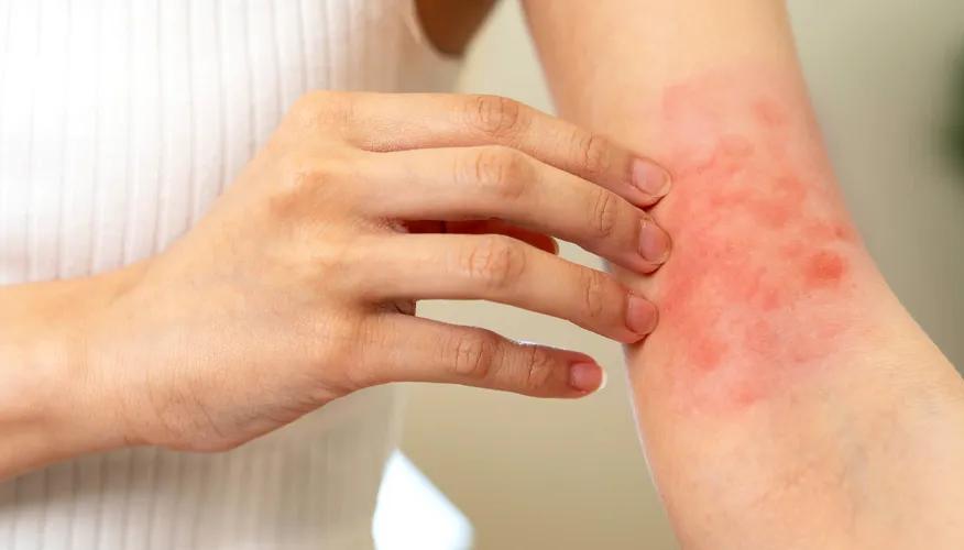 What are the complications that may occur due to dry skin in winter