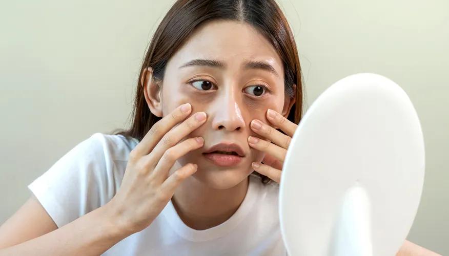 Dark Circles and Puffiness