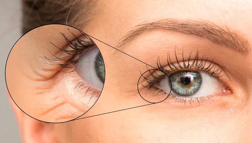 Fine Lines and Wrinkles