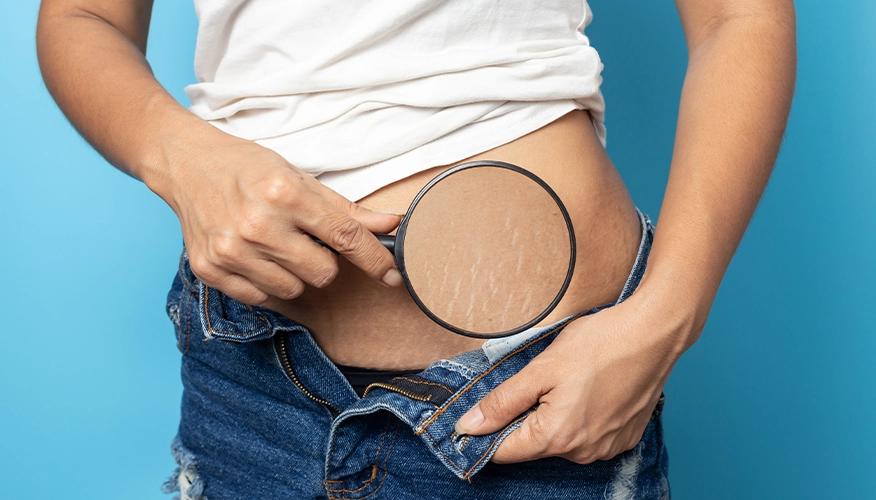 What Are Pregnancy Stretch Marks?