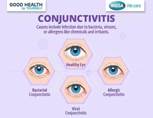 Conjunctivitis