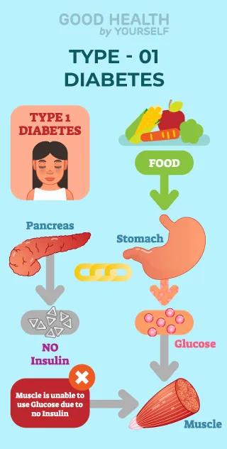 Type 1 diabetes